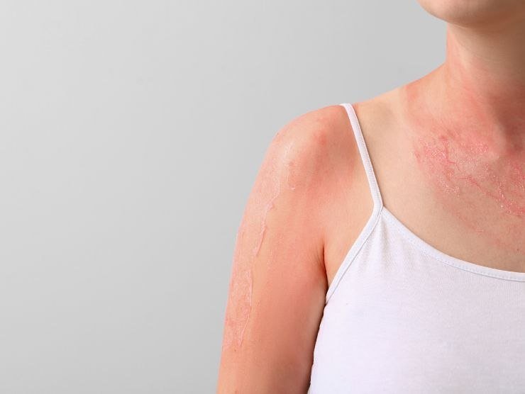 pelle arrossata e desquamata da una scottatura solare